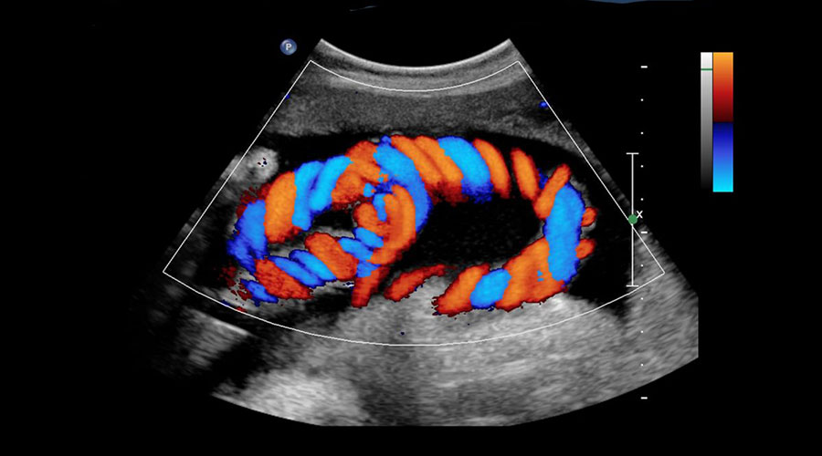 Renkli Doppler Ultrasonografi